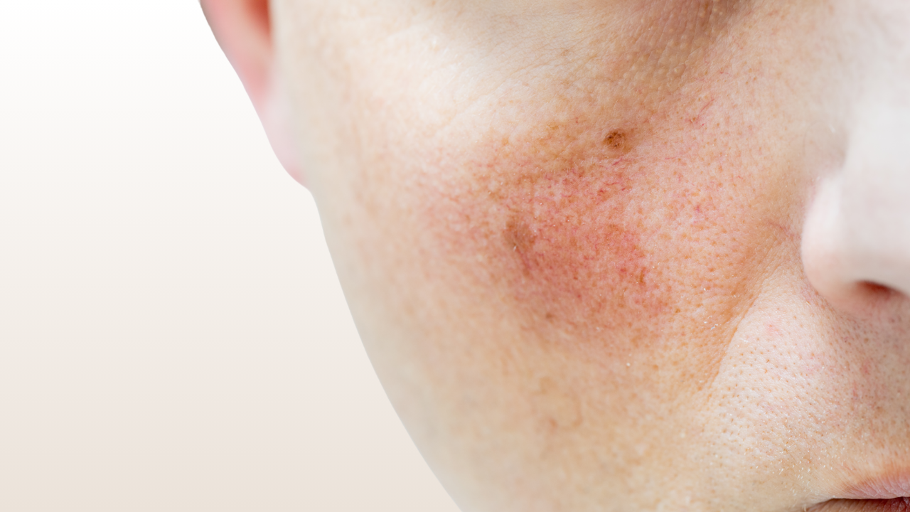 Laseroterapia Alma Dye VL