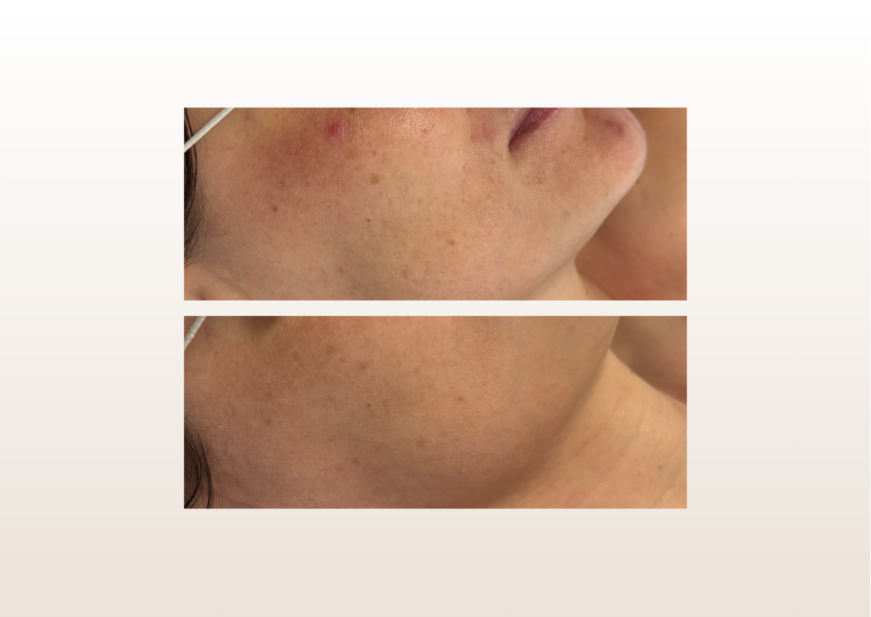 Przebarwienia posłoneczne/potrądzikowe/melasma